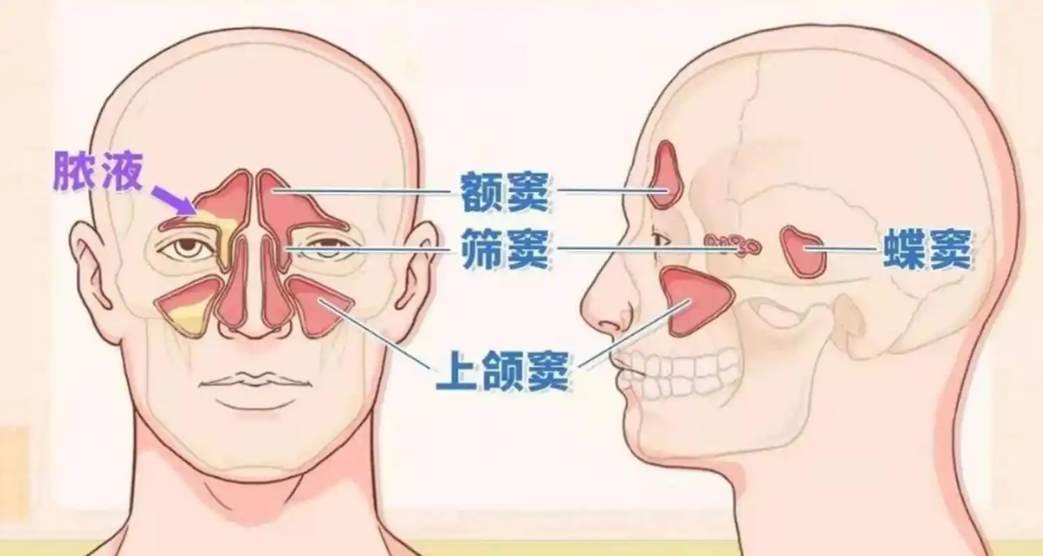 过敏性鼻炎：从认识到预防