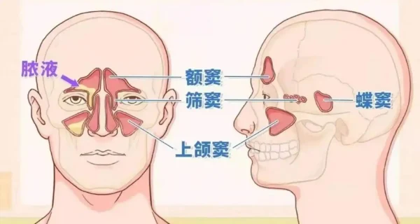 过敏性鼻炎:从认识到预防