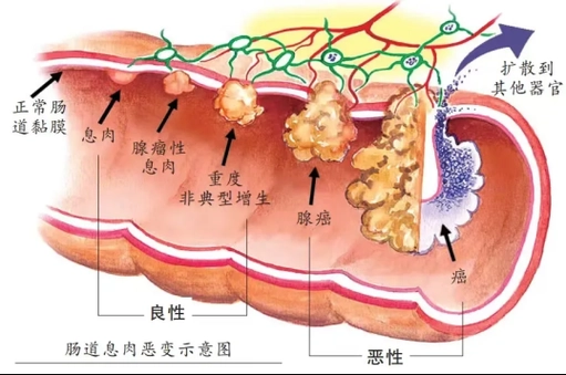 直肠癌诊断——这些症状你需要注意!